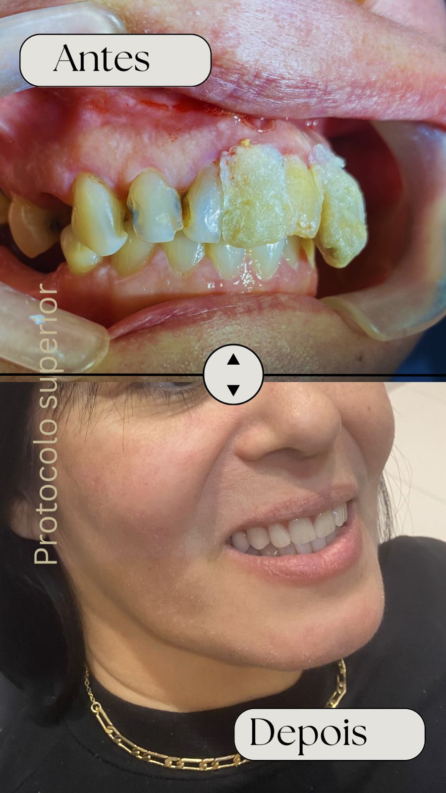 Antes e depois — Protocolo Superior