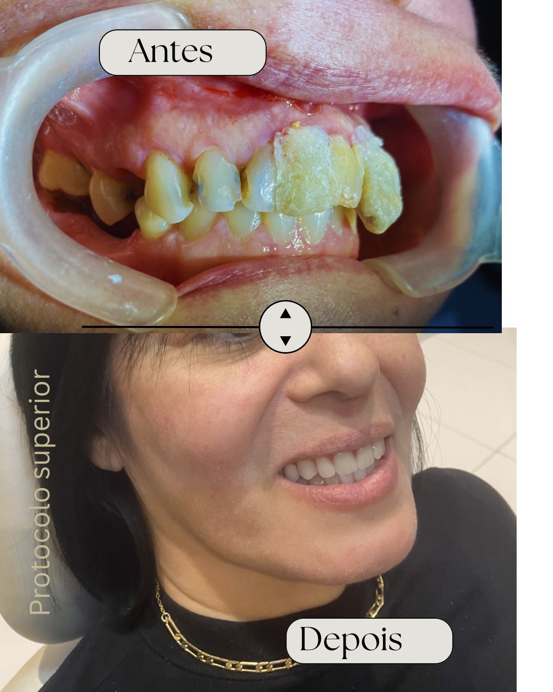 Antes e depois — Protocolo superior, dentadura parafusada