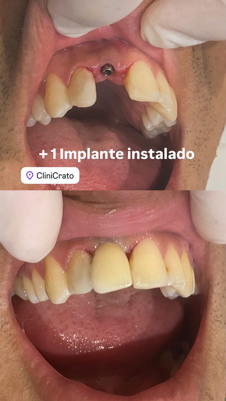 Implante dentário instalado — antes e depois